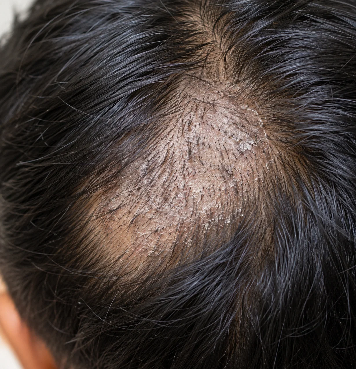 AI-generated realistic clinical illustration of tinea capitis showing a scaly black-dot hair-loss patch with broken hair shafts