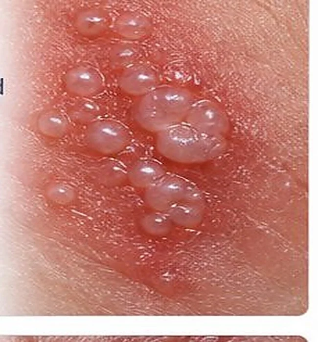 Grouped blisters on non-genital skin (illustration) — AI-generated medical illustration, not an actual patient photograph