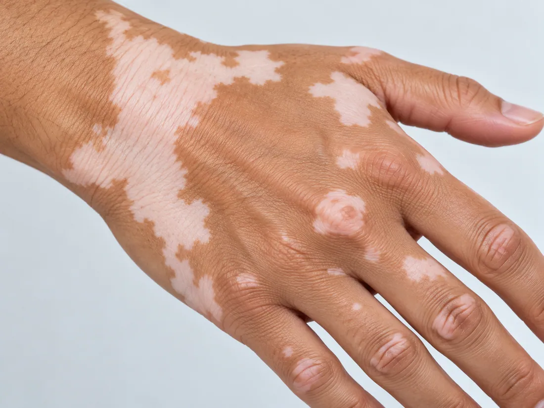 Clinical illustration of vitiligo on the hand