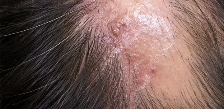 Scarring alopecia with shiny inflamed scalp and loss of hair follicles