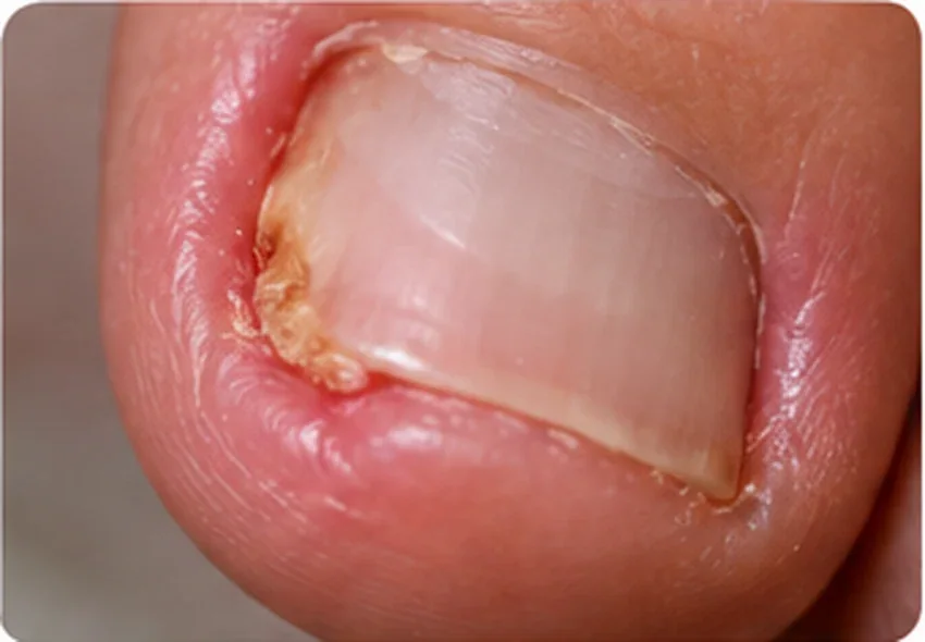 Illustration of inflamed nail fold at the edge of an ingrown great toenail
