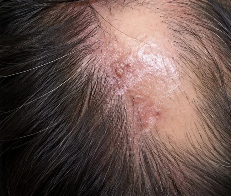 Close-up medical illustration of scarring alopecia showing a smooth shiny scalp patch with loss of follicular openings and surrounding hair