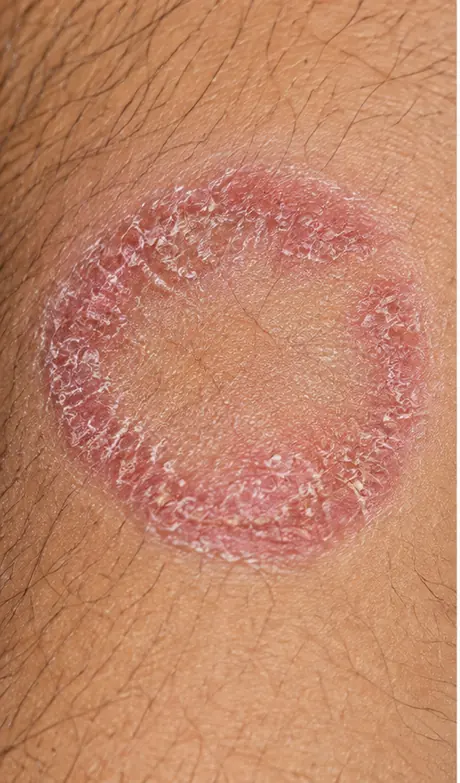 Illustration showing a ring-shaped scaly patch resembling ringworm on brown skin