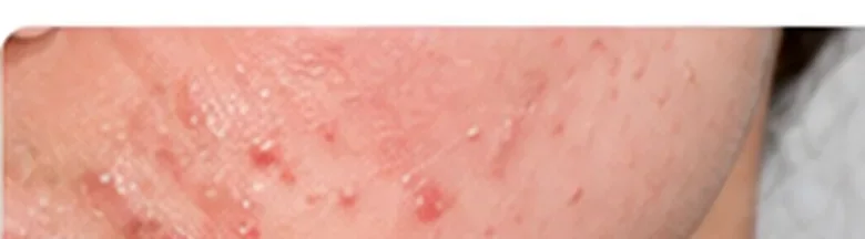 Clinical photograph representing acne and skin concerns