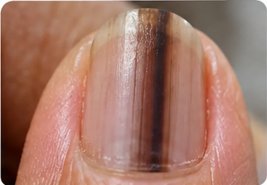 Illustration of a longitudinal brown pigmented band of a fingernail