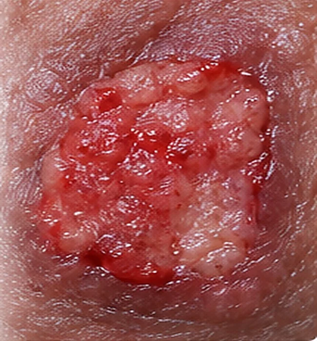 Illustrative chronic ulcer close-up on non-identifiable skin — AI-generated medical illustration, not an actual patient photograph
