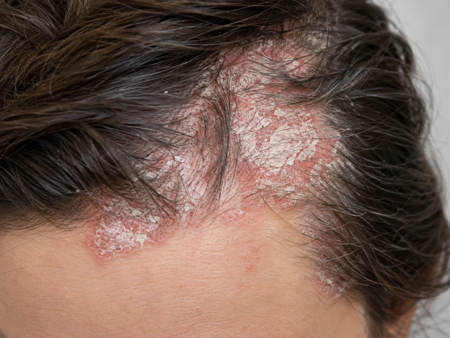 AI illustration of psoriasis affecting the scalp