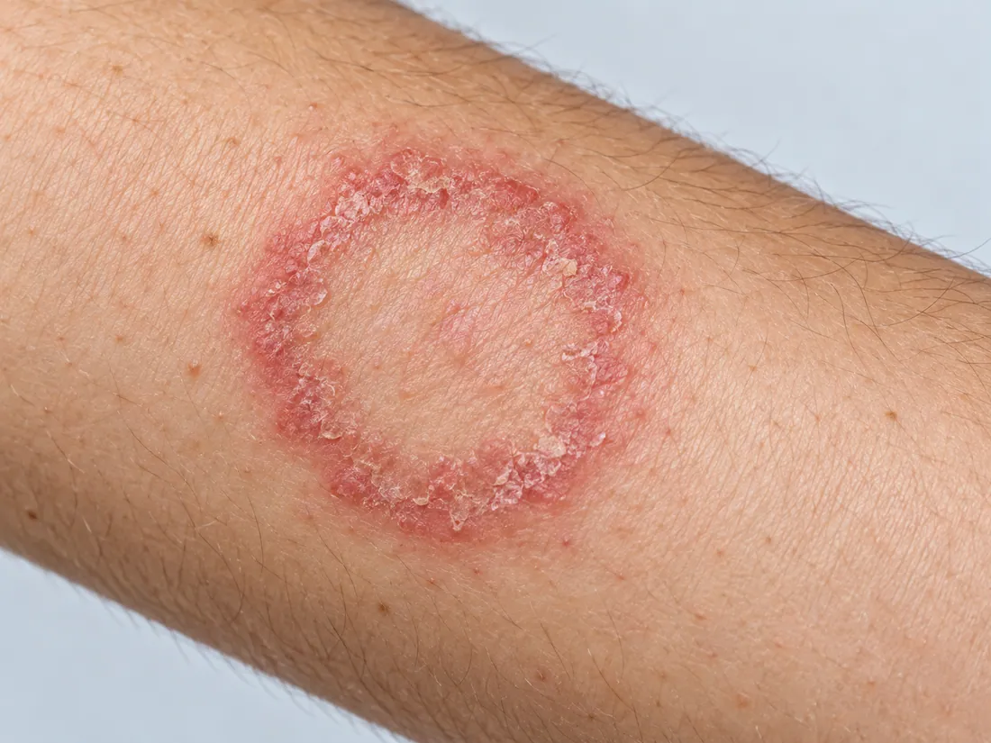 Clinical illustration of ringworm on skin