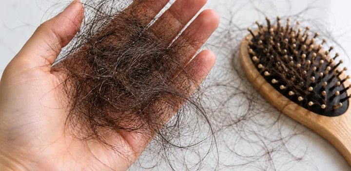 Shed hair collected in a hand, illustrating telogen effluvium