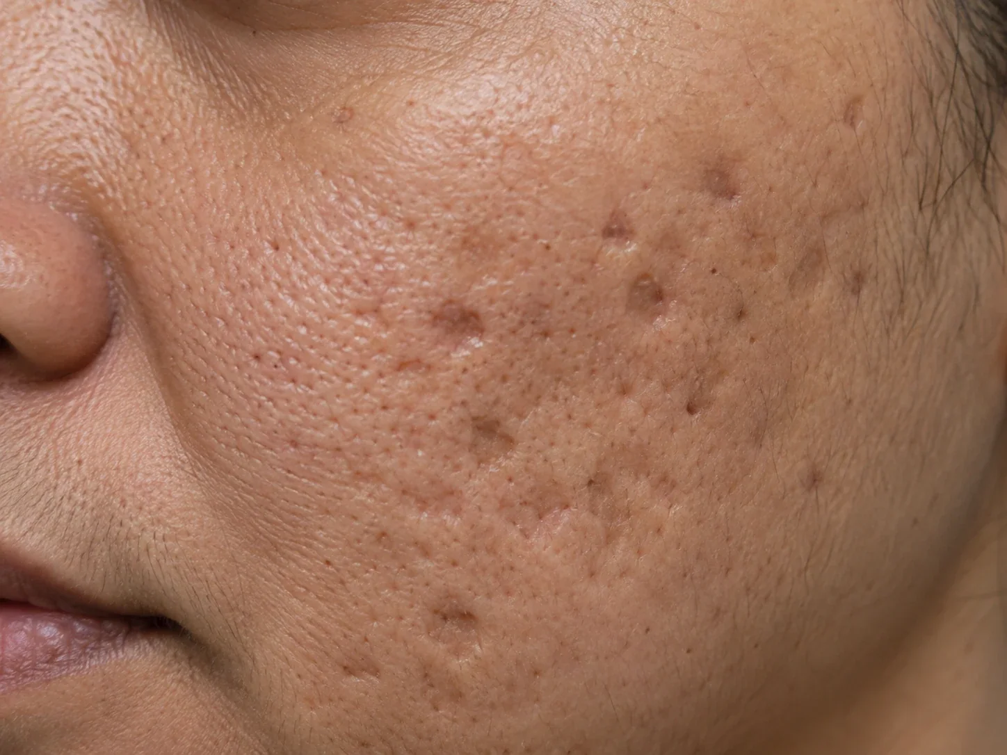 Clinical-style close-up of boxcar acne scars on the cheek