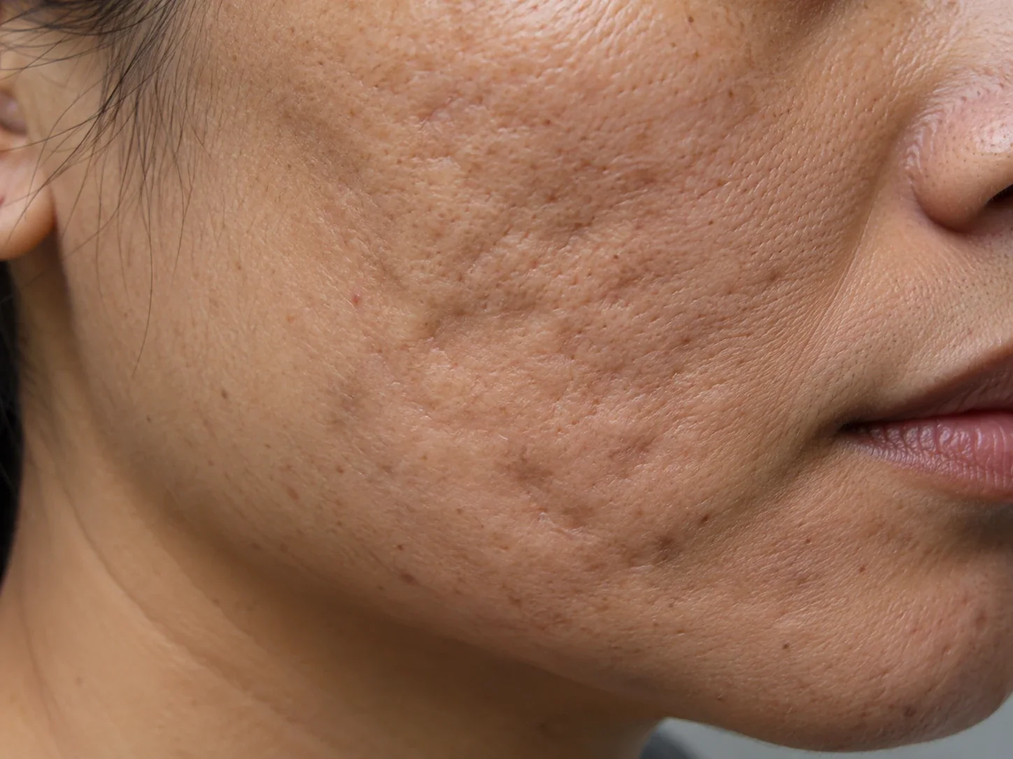 Clinical-style close-up of rolling acne scars on the cheek