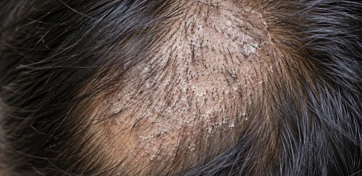 Scaly patch of hair loss due to tinea capitis