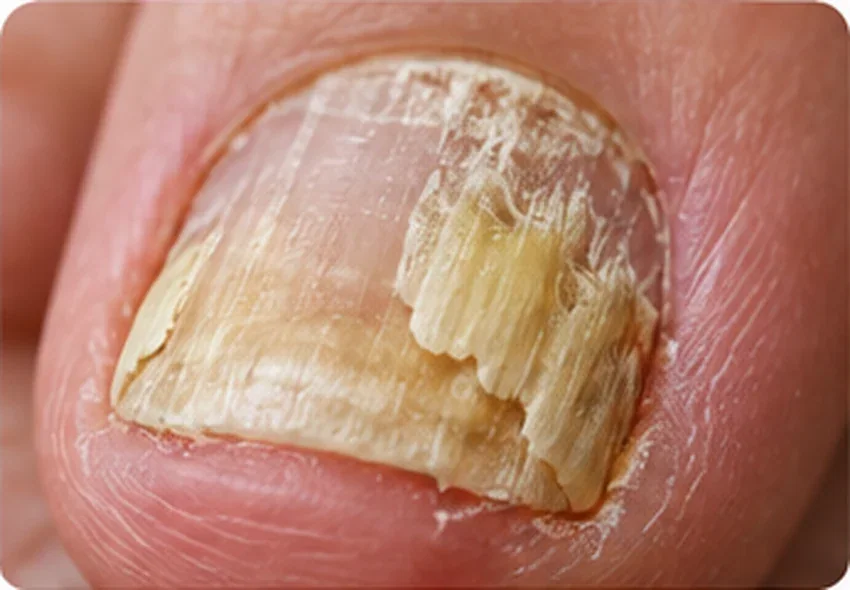 Illustration of yellow, thickened, crumbly toenail compatible with fungal infection
