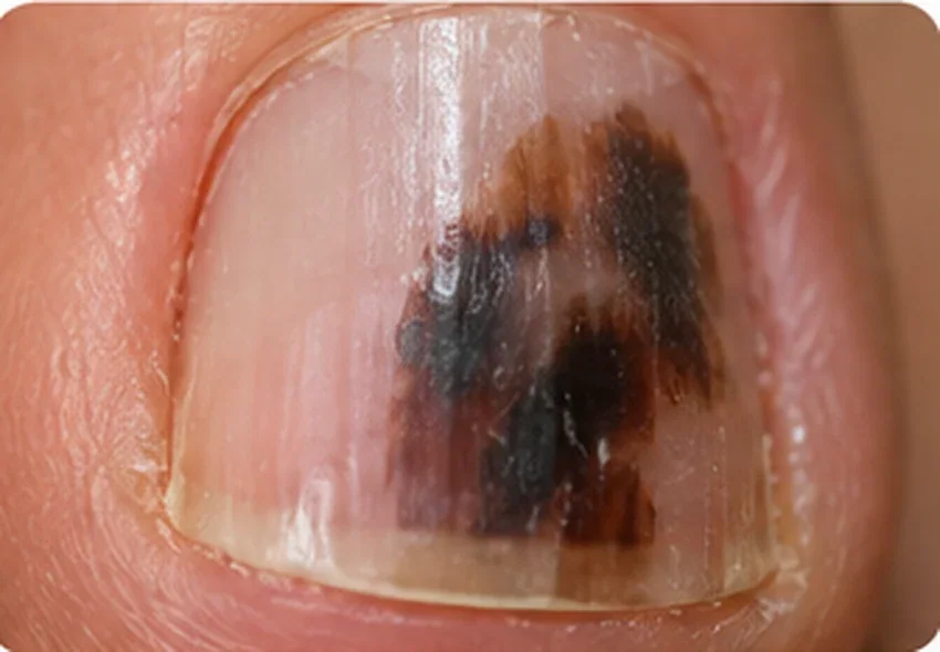 AI-generated illustrative image of an irregular dark pigmented lesion of a nail; not diagnostic