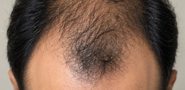 Male pattern hair loss showing recession and thinning at the crown